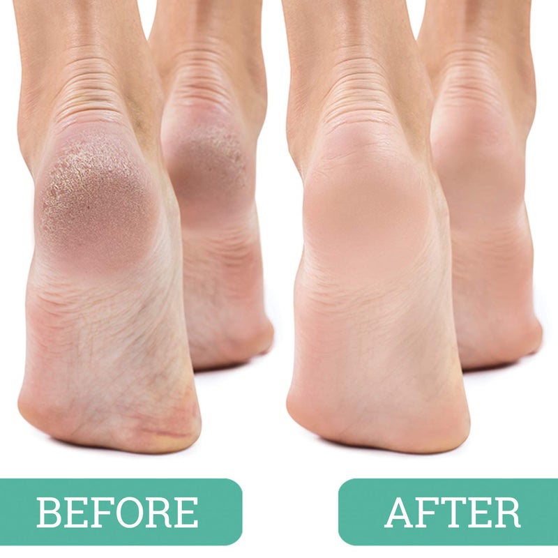 Maccibelle Salon Foot Pumice and Scrubber for Feet and Heels Callus and Dead Skins  Safely and Easily Eliminate Callus and Rough Heels (Pack of 1) - Image 3
